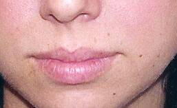 Lips and Lipliner - Permanent Makeup Before After Photos