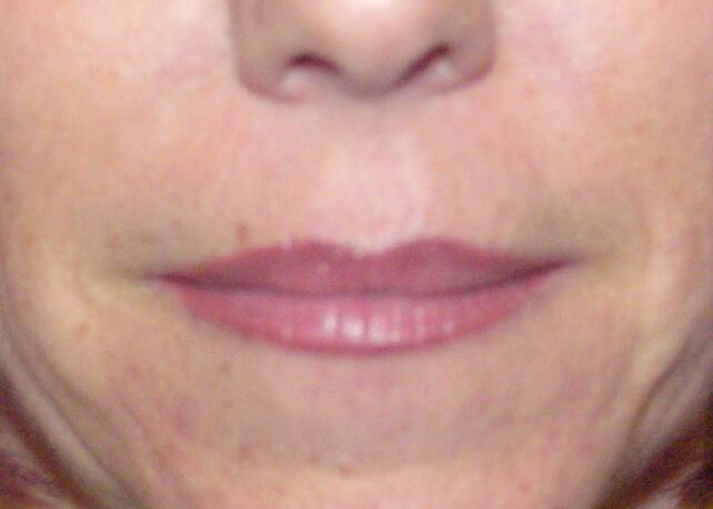 Lips and Lipliner - Permanent Makeup Before After Photos